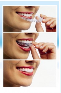 Invisalign 0