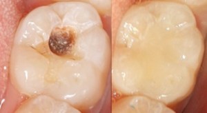 otturazioni-denti-posteriori